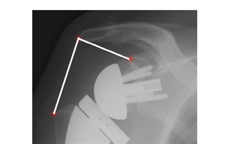 Uw Shoulder And Elbow Academy Reverse Total Shoulder Arthroplasty Do