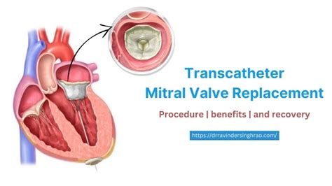 Transcatheter Mitral Valve Replacement Tmvr Procedure Benefits