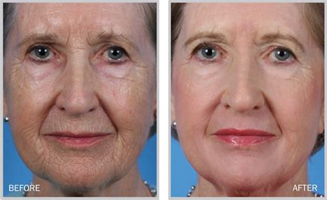 Skin Resurfacing Dr Beth Comeau Md Laser Skin Resurfacing