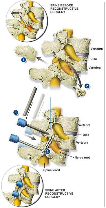 Spinal Fusion Southeastern Spine Institute Spinal Fusion Surgery