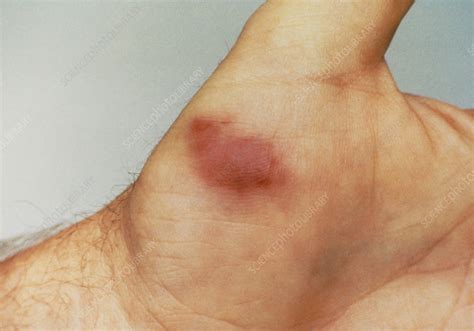 Kaposis Sarcoma On The Hand Of An Aids Patient Stock Image M1120084