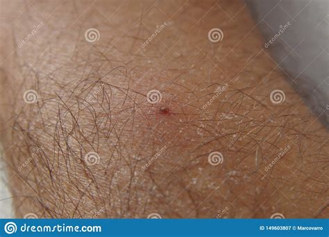 Tick Bite Arm Stock Image Image Of Encephalitis Design 149603807
