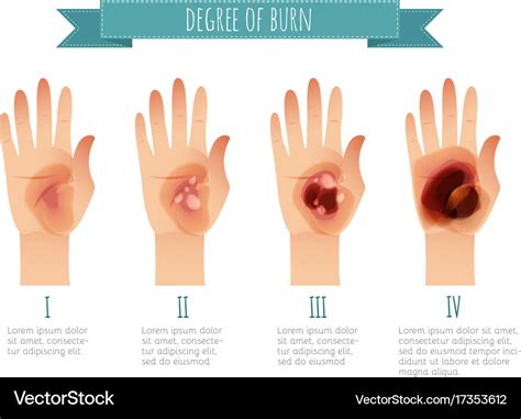 Degree Of Skin Burns Flat For Royalty Free Vector Image