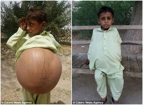 Meet 9 Year Old Boy Who Is Pregnant Due To Rare Disease Photos
