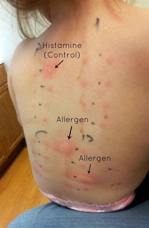 Allergy Skin Test Results Chart