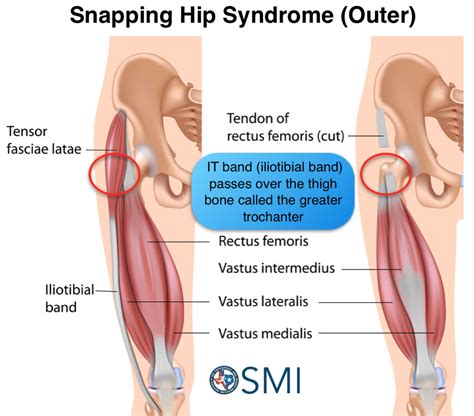 Snapping Hip Syndrome The Orthopedic And Sports Medicine Institute In Fort Worth