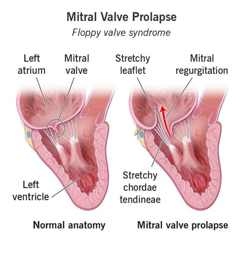 Pathophysiology Of Mitral Valve Sexiz Pix