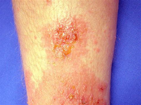 Childhood Rashes Skin Conditions And Infections Photos Babycenter