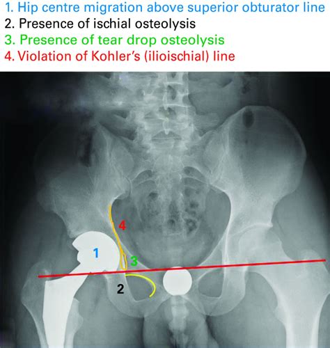 Acetabular Distraction Bone And Joint