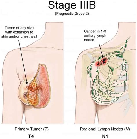Ibc can be very aggressive and can progress quickly. Breast Cancer - Causes, Signs, Symptoms, Types, Treatment