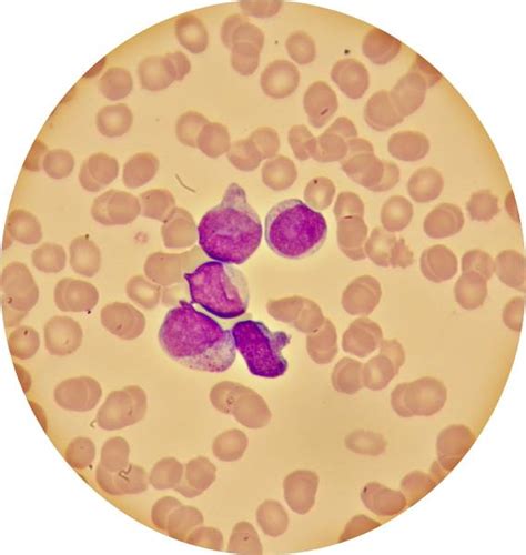 La leucemia y otras enfermedades de la sangre y la médula ósea pueden afectar los glóbulos rojos, los glóbulos blancos y las plaquetas. Leucemia mieloide aguda - frotis de sangre - DocCheck Pictures