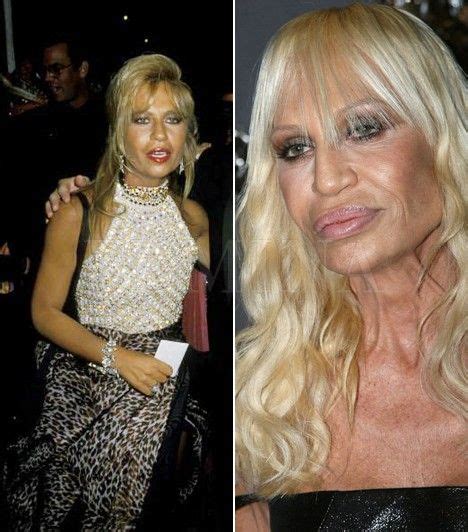 Donatella Versace Plastic Surgery Gone Wrong Celebrity Plastic