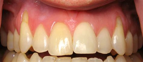 Receding Gums What Are The Causes Treatment Surgery And Prevention