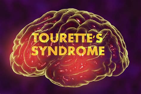 Tourette syndrome or tourette's syndrome (abbreviated as ts or tourette's) is a common neurodevelopmental disorder that begins in childhood or adolescence. How to Document Tourette Syndrome with the Right Medical Codes