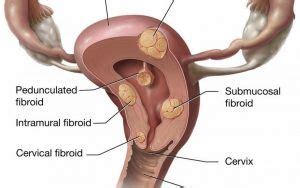 It is high in fats, contains. 5 Signs You Might Have Uterine Fibroids | Fibroids, Uterine fibroids, Fibroid uterus