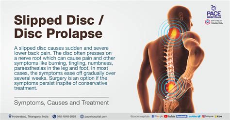 slipped disc symptoms causes and treatment disc prolapse