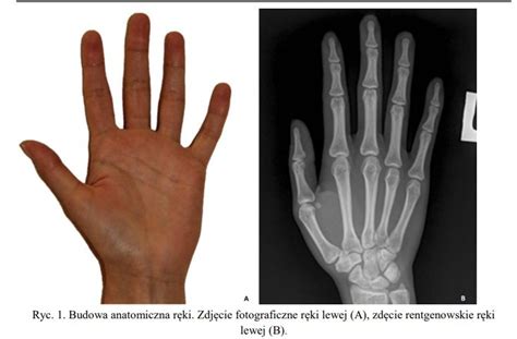 The Anatomical Structure Of The Hand Photo Of The Left Hand A X Ray