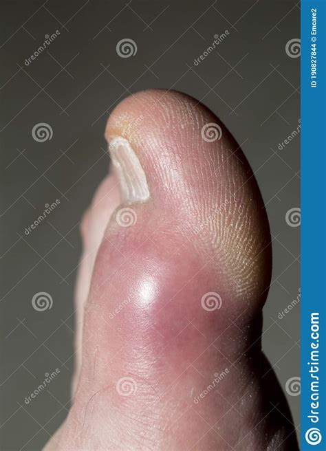 The Left Foot Big Toes With Gout Stock Photo Image Of Gout Anatomy