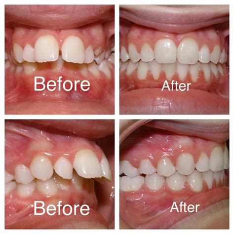 Wonderful Results With Braces And Mara Appliance At Amanda Gallagher