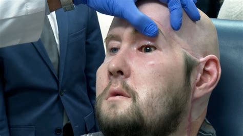 History Made As Man Receives The Worlds First Whole Eye Transplant