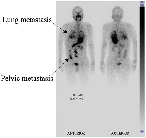 Cureus Papillary Thyroid Cancer With Pituitary Gland Metastasis A