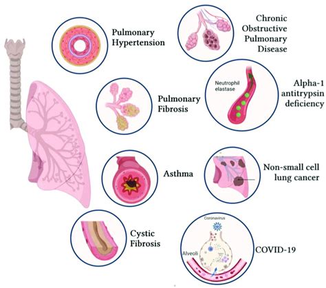 Common Respiratory Diseases Associated With Genetic Disorders Or