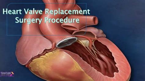 Heart Valve Replacement Surgery Procedure
