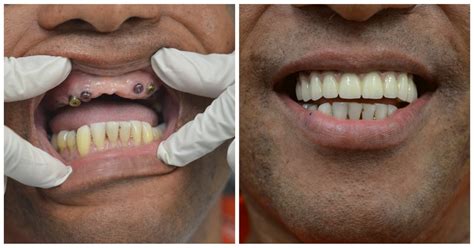 Dental Crowns Manhattan Implant Supported Bridge 209 Nyc Dental