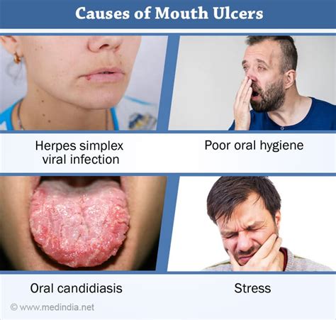 What Is Mouth Sores Cause Symptoms Treatment And Prevention My Xxx