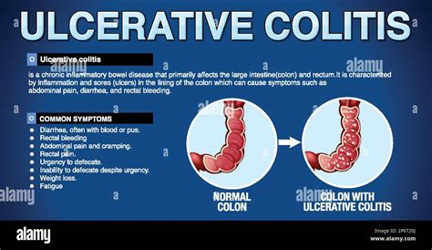 Ulcerative Colitis Symptoms Infographic Illustration Stock Vector Image