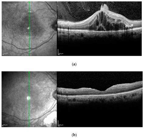 Jcm Free Full Text Role Of Vitrectomy In Nontractional Refractory
