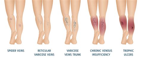 Chronic Venous Ulcers Adelaide, SA | Chronic Venous Insufficiency (CVI) Norwood, SA