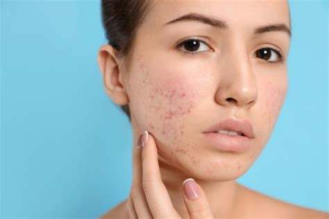 Skincare Routine Faqs When Should I See A Dermatologist For Acne