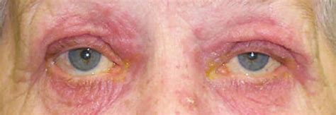 Ocular Rosacea Causes Triggers Symptoms Eye Drops Treatment