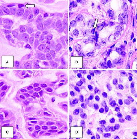 Cytologic Features Of Polymorphous Sweat Gland Carcinoma Psgc Larger