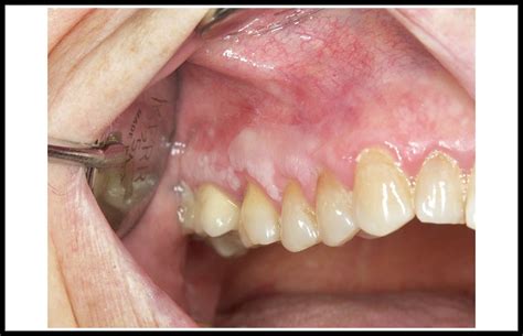 Leucoplasia Oral Una Revisión De Los Aspectos Esenciales De Su
