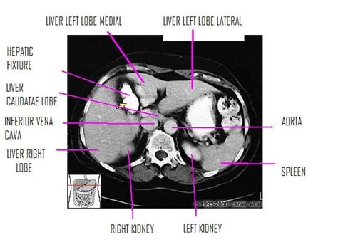 Ct Scan Tips And Protocols Liver Lateral And Medial Left Lobe In Ct Scan