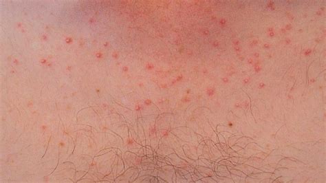 bumps on chest small red rashes acne vulgaris and bumps not acne american celiac 2024