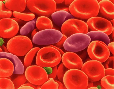 Sickle Cell Human Blood Photograph by Dennis Kunkel ...