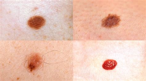 Mole Vs Skin Tag Understanding The Difference 2023