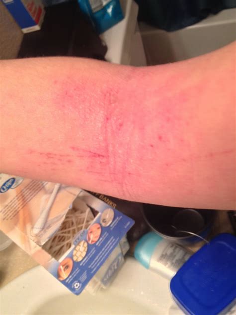 Scratching The Surface Of Topical Steroid Withdrawal Day 19 Fragile Skin