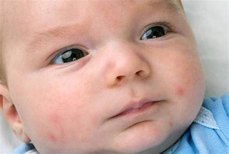 Common Causes Of Red Spots On Baby Skin Air Clinic