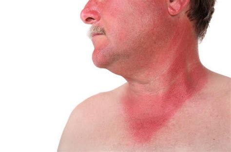 Wear a panty liner if the cream is soiling your clothes. How Long Does Sunburn Last & How To Get Rid Of It (30 ...