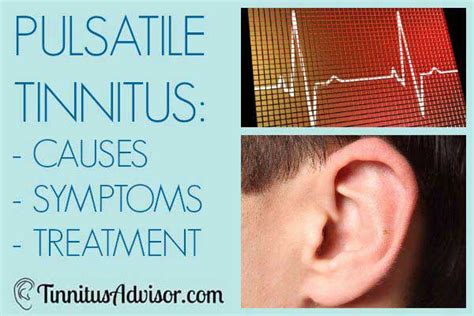 Pulsatile Tinnitus Causes Symptoms And Treatment