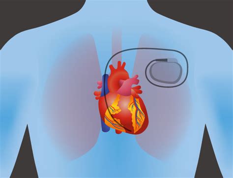 Pacemaker Placement Cardiovascular Institute Of The Shoals