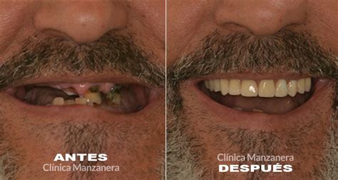 Implantes Inmediatos Tu Sonrisa En 24 Horas Caso Real Clinica