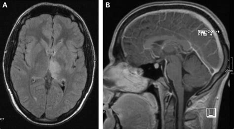 Deep Cerebral Vein Thrombosis Misdiagnosed As Tumour Emergency
