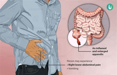 Human Appendix Pain