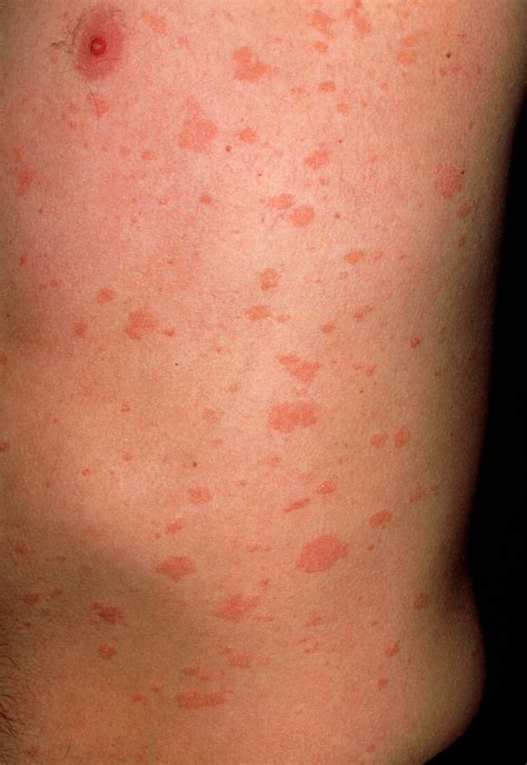 Pityriasis Rosea Skin Rash By Cnri Science Photo Library Lupon Gov Ph The Best Porn Website