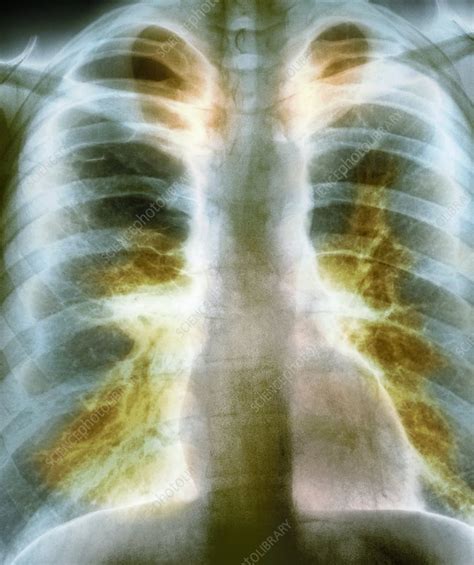 Bullous Emphysema X Ray Stock Image C0072676 Science Photo Library
